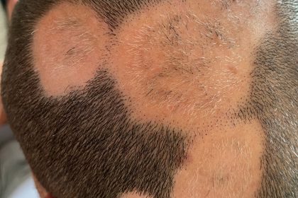 Outsmart alopecia areata